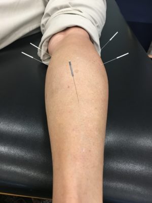 Dry Needling